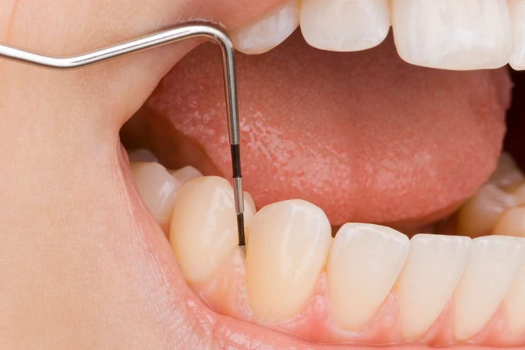 歯周病検査・基本治療