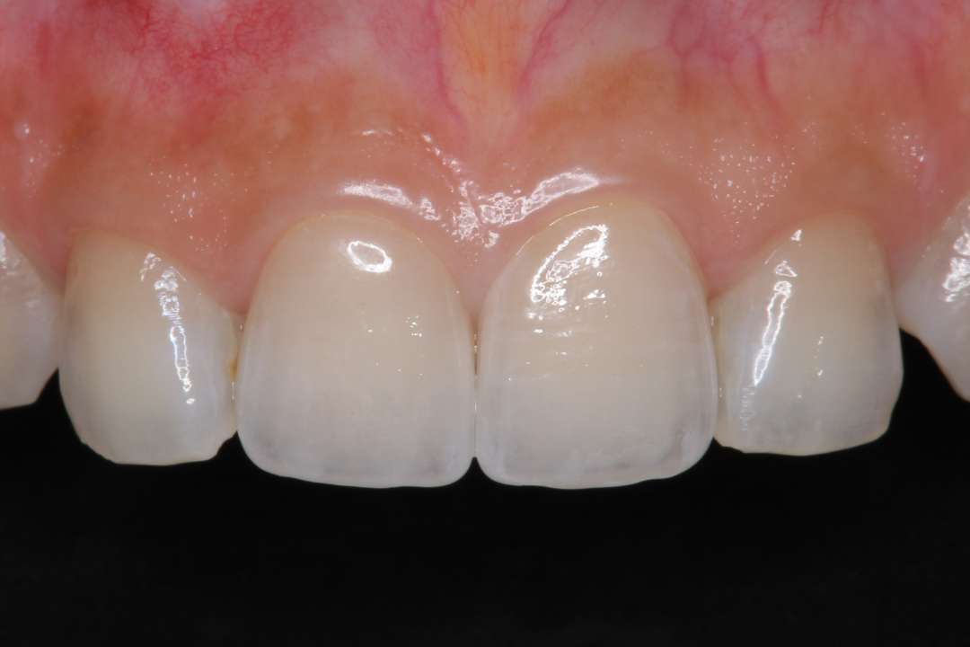 1回の施術で歯を美しくできる「ダイレクトボンディング」
