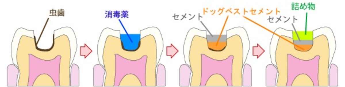 ドッグスベストセメントを用いた治療の流れ
