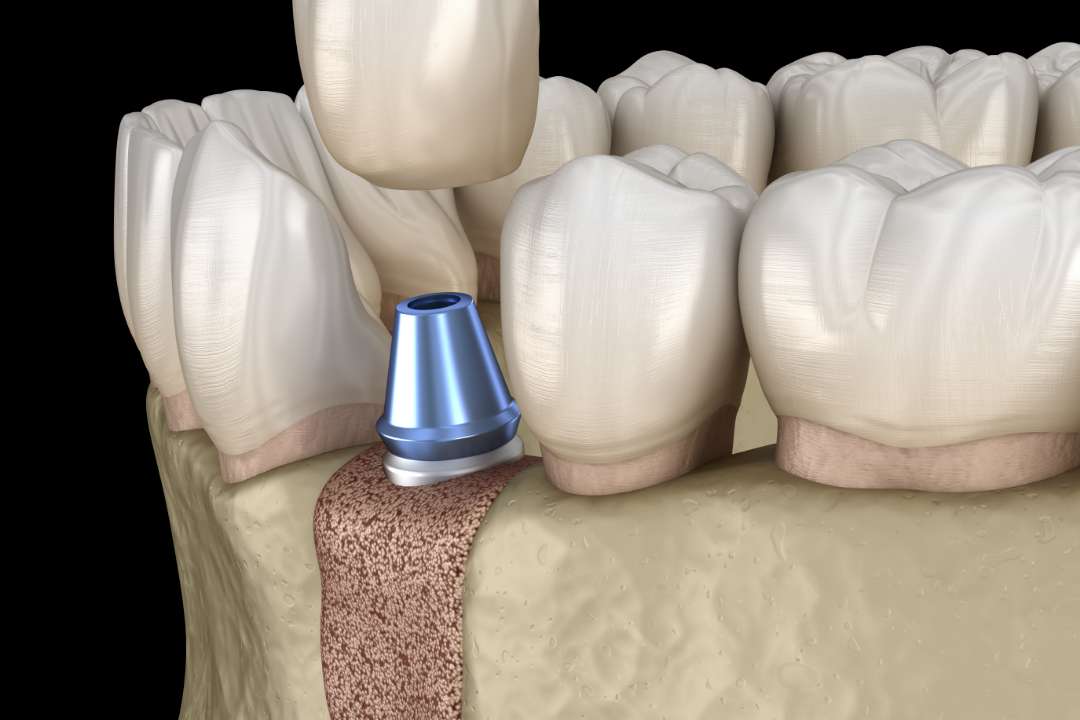 顎骨の厚みを再生させる「GBR法（骨誘導再生法）」