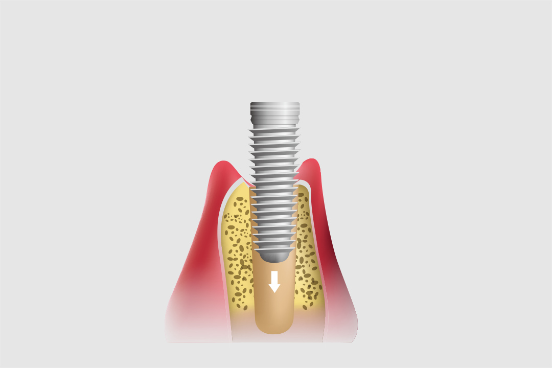 インプラント体の埋入手術