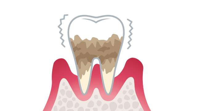 P4 重度歯周炎
